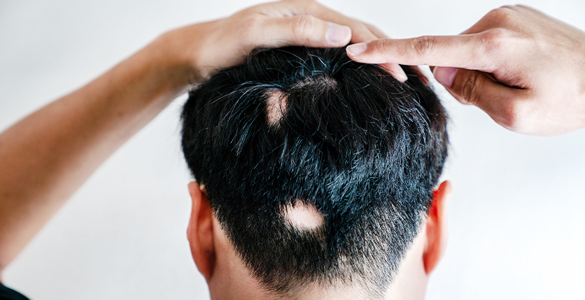 Back view of man's head with bald spots