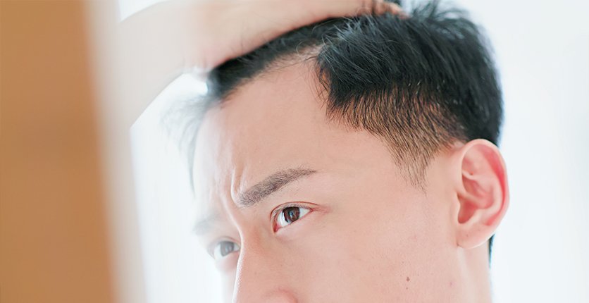 Male pattern hair loss is mainly driven by genetics